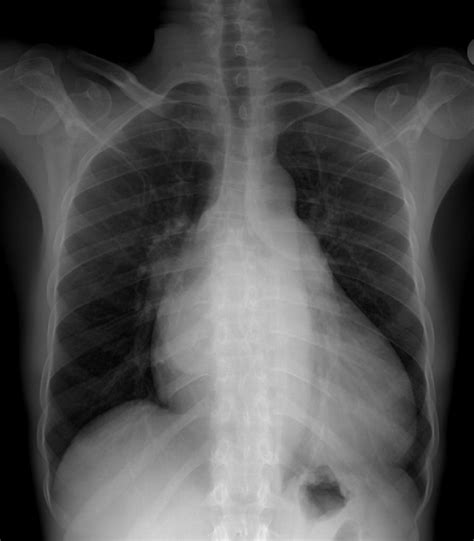 enlarged lv|left ventricular enlargement x ray.